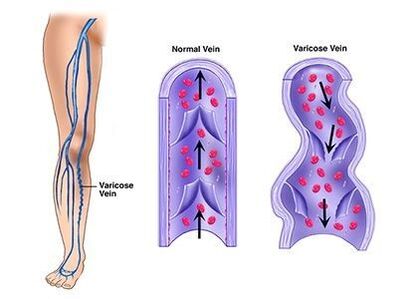 Neoveris prevents the development of vascular pathologies