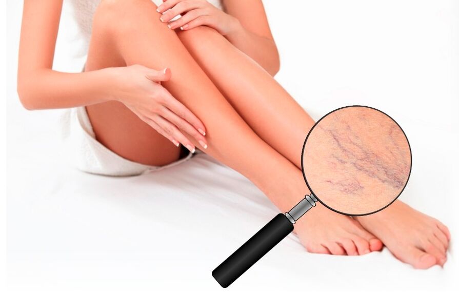 Neoveris will protect your feet from varicose veins