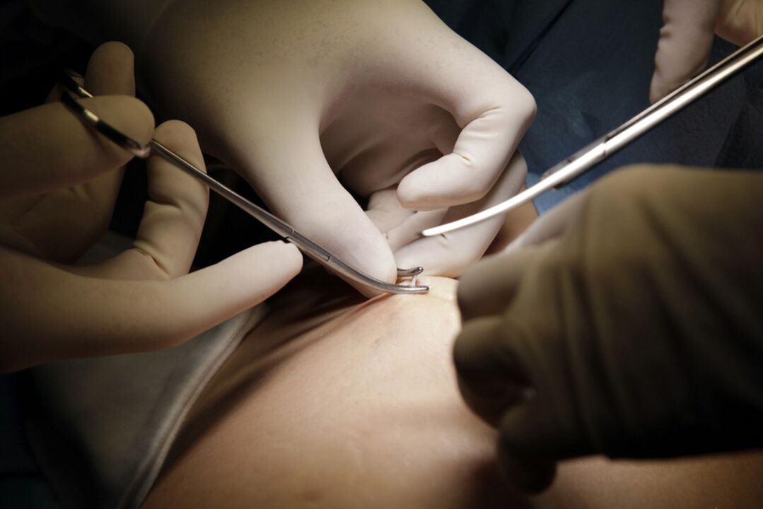 Surgical intervention