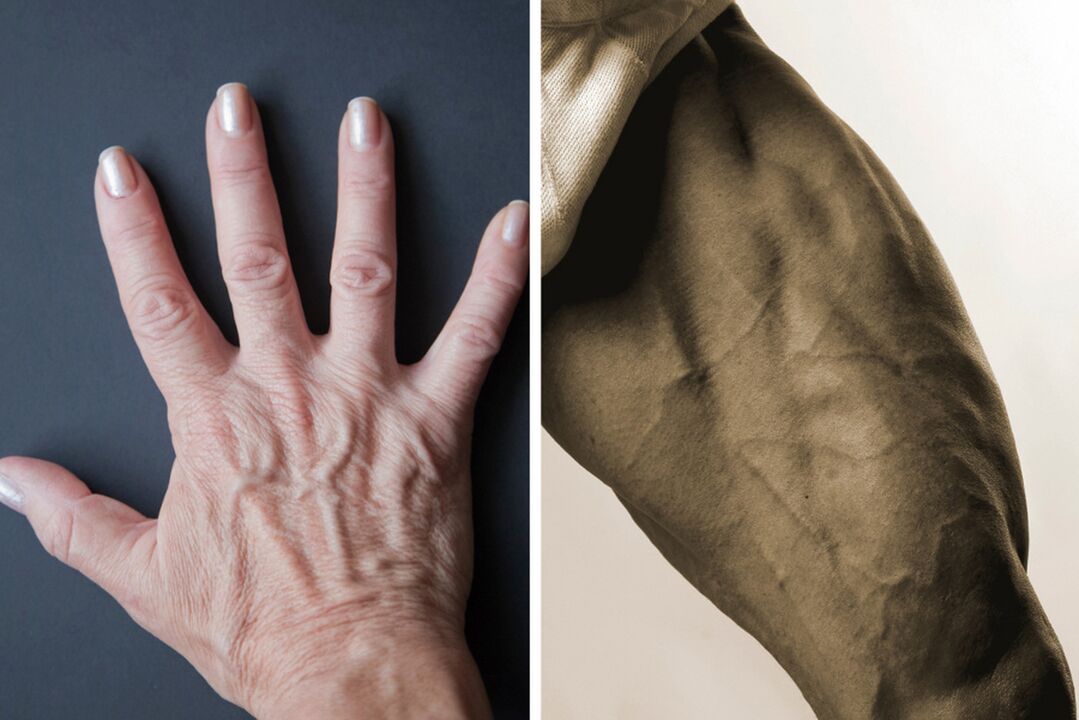 Symptoms of varicose veins