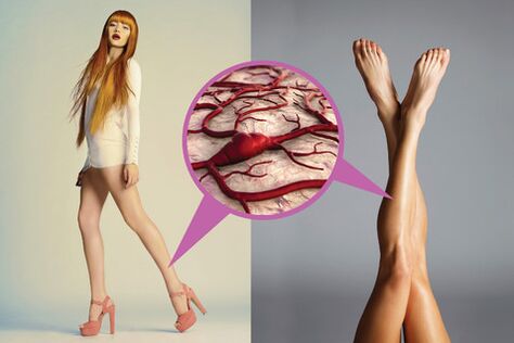 Varicosis veins in the legs