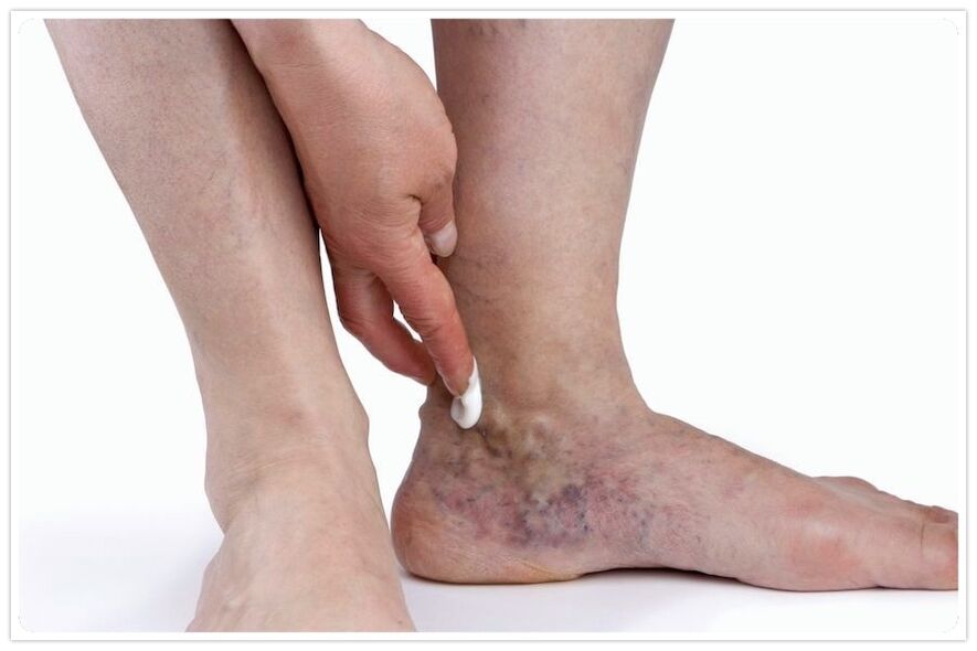 Benefits of the procedure to the veins