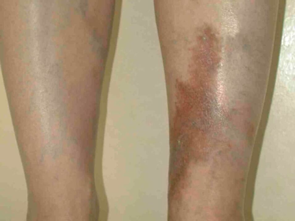 Stages of varicose veins