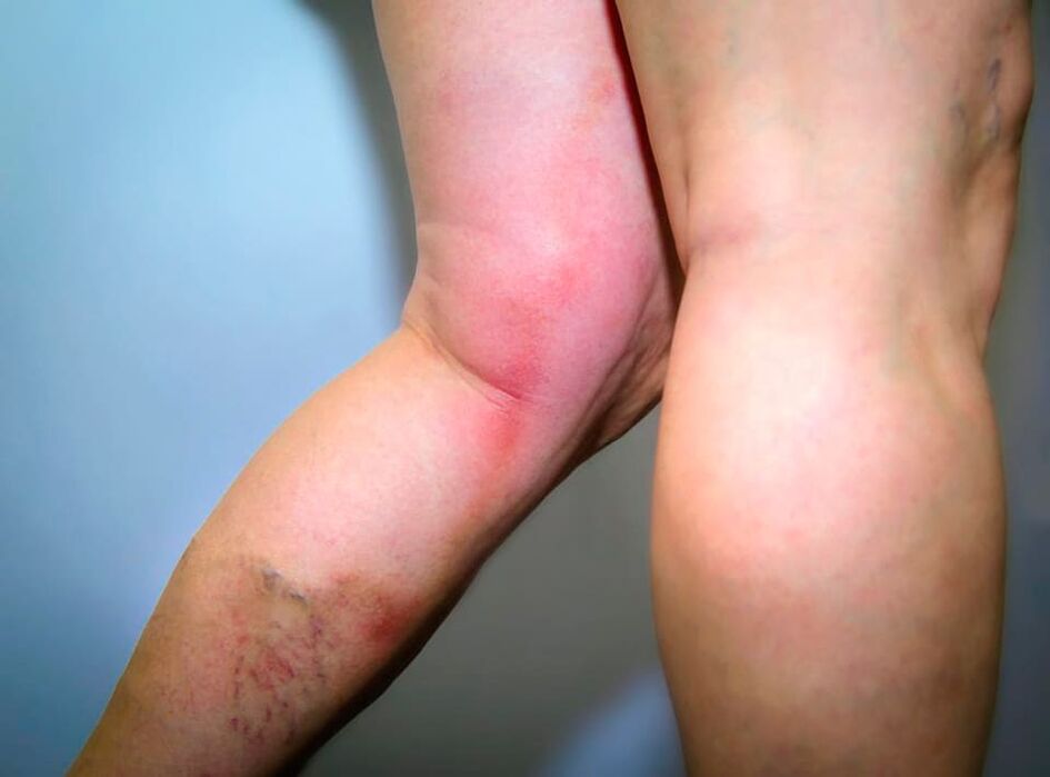The results of varicose veins