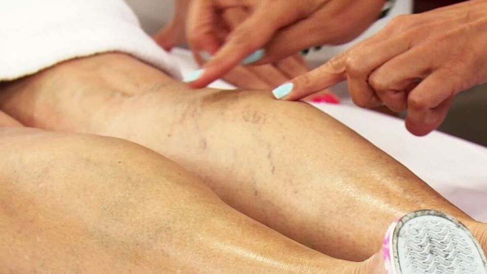 Varicosis veins in the lower leg