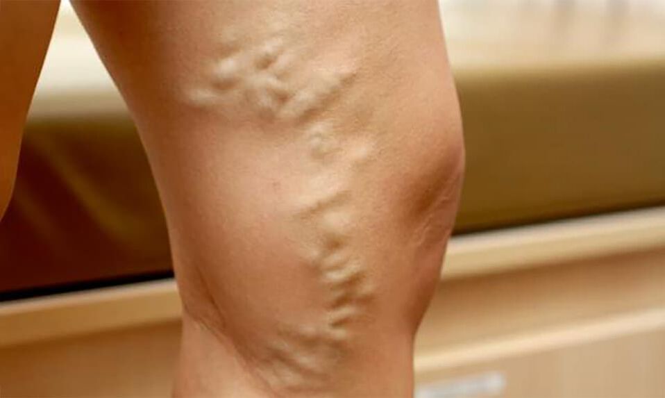 Varicosis veins on the foot