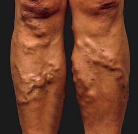 Varicose veins