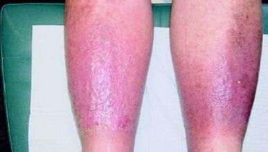 the third stage of varicose veins in the legs