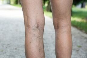 manifestations of varicose veins in the legs