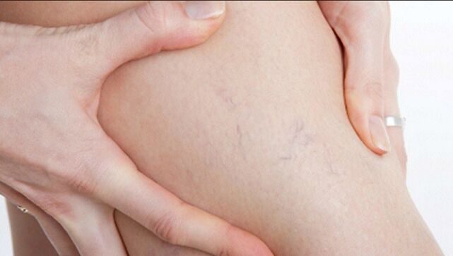 Spider veins on the legs are a sign of varicose veins