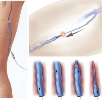 treatment method of varicose veins - endovenous laser coagulation