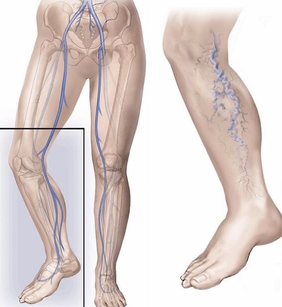 healthy veins and veins affected by varicose veins