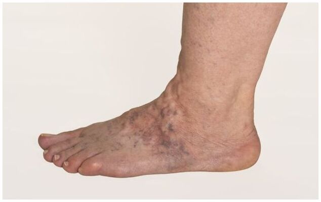 Varicose veins in a man's leg are complicated by trophic ulcers