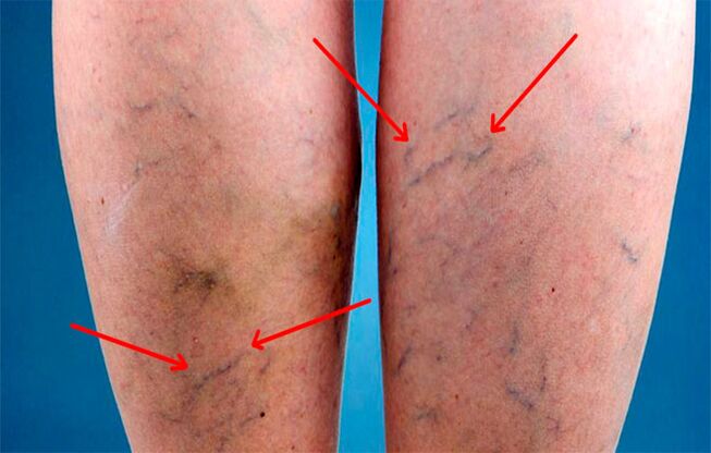 Veins in the legs with varicose veins