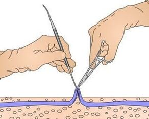 Miniflebectomy - removal of the affected part of the vein from varicose veins