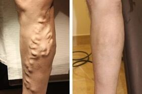 The result of surgery to remove varicose veins of the legs