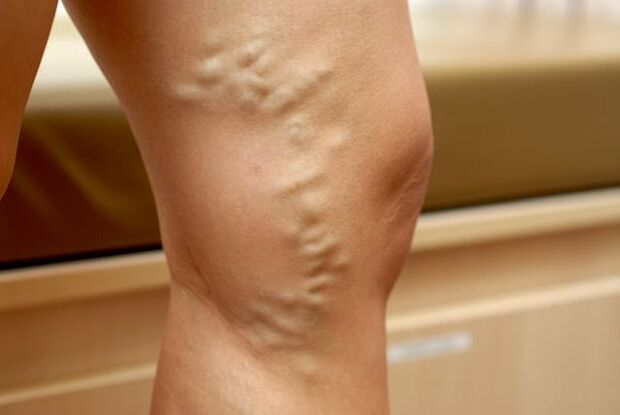 In stage 3, a protruding deformed vein in the leg with varicose veins