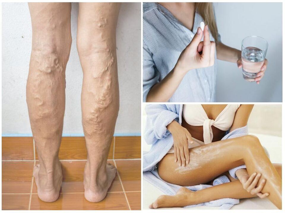 Varicose veins of the lower extremities and its treatment