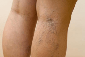 photo of varicose veins in the legs